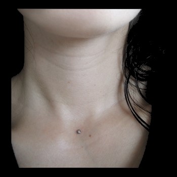 implant au cou implant au cou